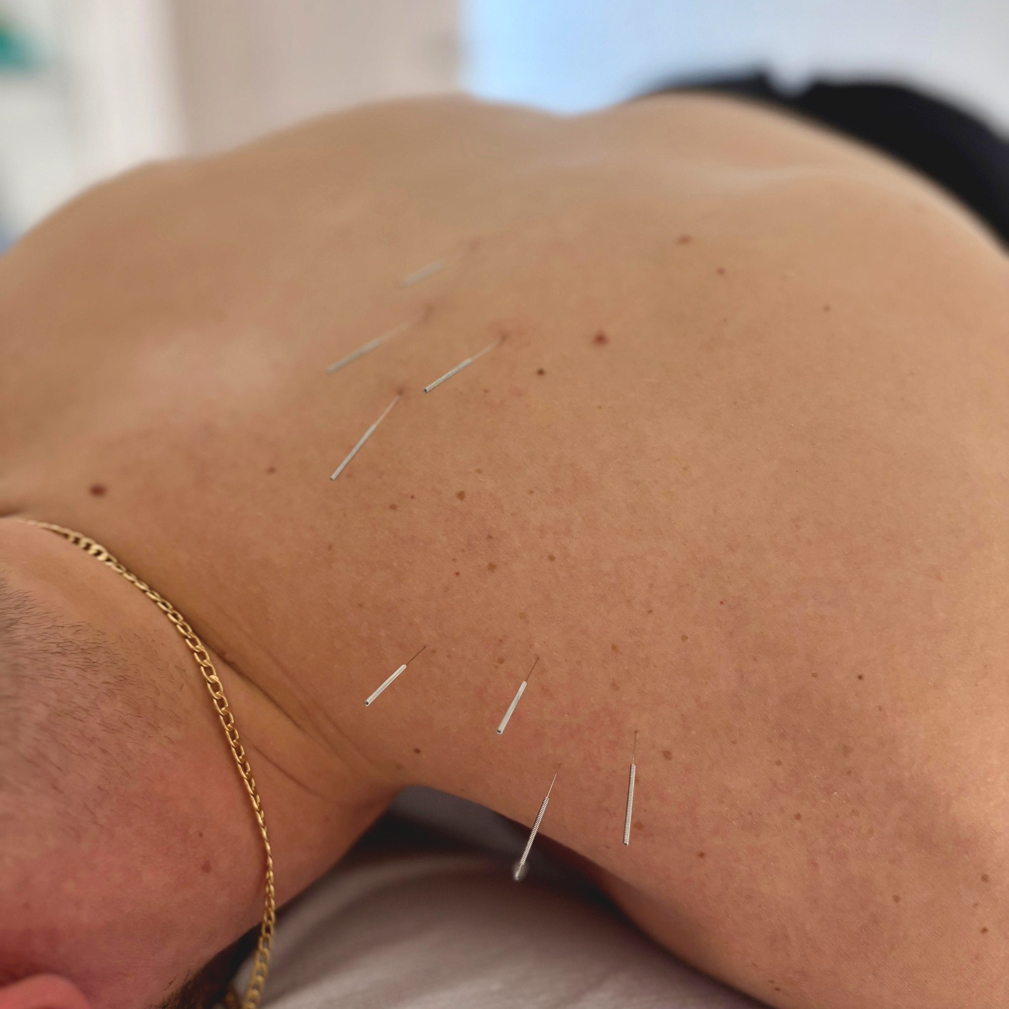 Dry Needling
